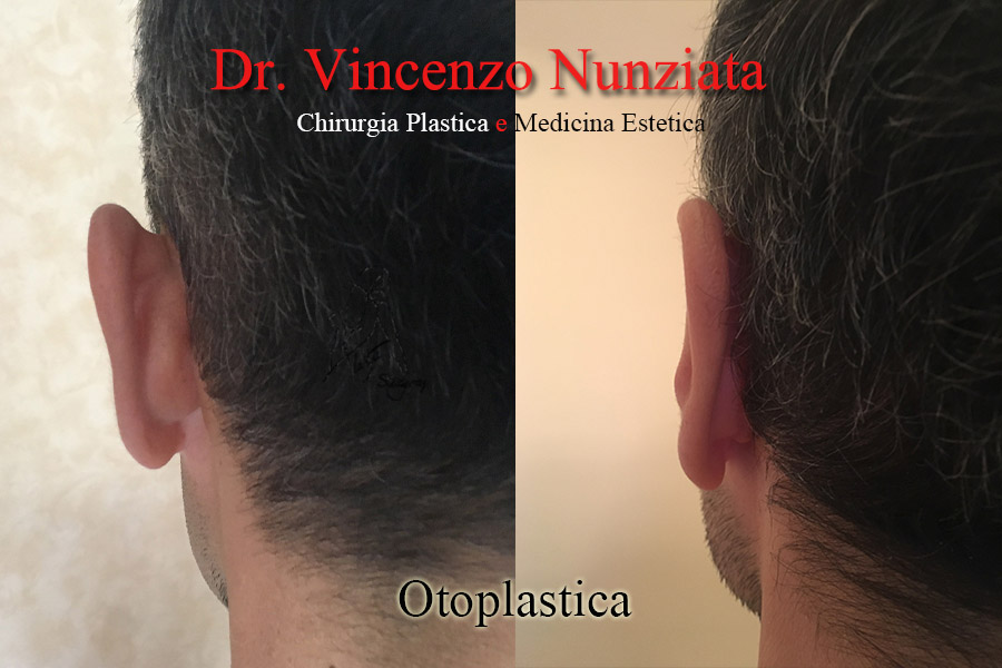Otoplastica prima e dopo – Paziente 9 – Dr. Vincenzo Nunziata, chirurgo plastico – foto 3