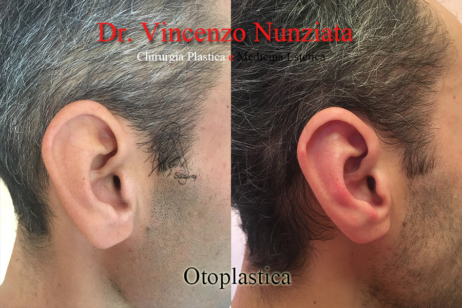 Otoplastica prima e dopo – Paziente 9 – Dr. Vincenzo Nunziata, chirurgo plastico – foto 2
