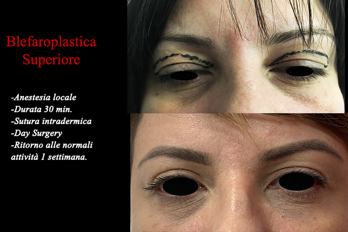 Blefaroplastica prima e dopo – Paziente 7 – Dr. Vincenzo Nunziata, chirurgo plastico – foto 1