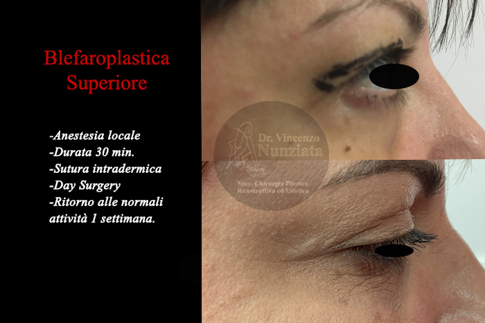Blefaroplastica prima e dopo – Paziente 7 – Dr. Vincenzo Nunziata, chirurgo plastico – foto 3