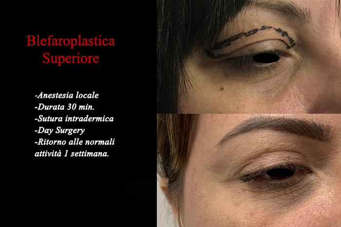 Blefaroplastica prima e dopo – Paziente 7 – Dr. Vincenzo Nunziata, chirurgo plastico – foto 2