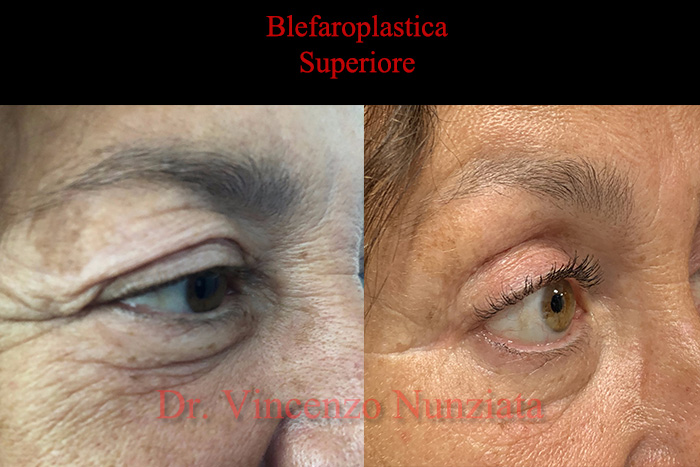 Blefaroplastica prima e dopo – Paziente 8 – Dr. Vincenzo Nunziata, chirurgo plastico – foto 2