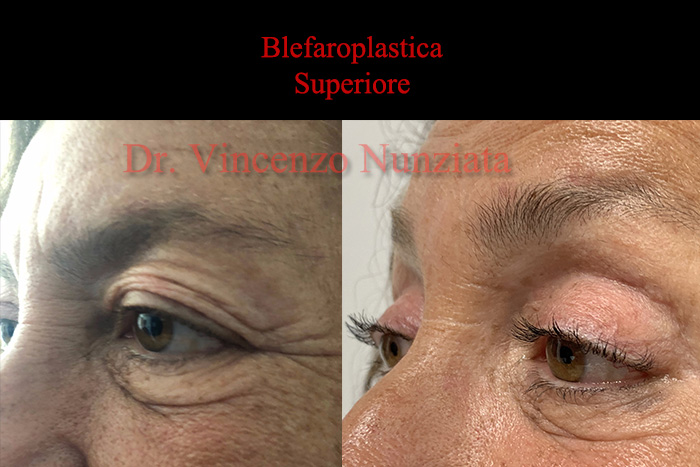 Blefaroplastica prima e dopo – Paziente 8 – Dr. Vincenzo Nunziata, chirurgo plastico – foto 3
