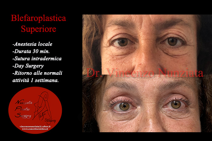 Blefaroplastica prima e dopo – Paziente 8 – Dr. Vincenzo Nunziata, chirurgo plastico – foto 1
