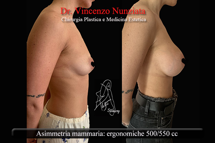 Asimmetrie mammarie prima e dopo – Paziente 5 – Dr. Vincenzo Nunziata, chirurgo plastico – foto 3