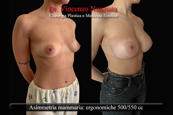 Asimmetrie mammarie prima e dopo – Paziente 5 – Dr. Vincenzo Nunziata, chirurgo plastico – foto 2