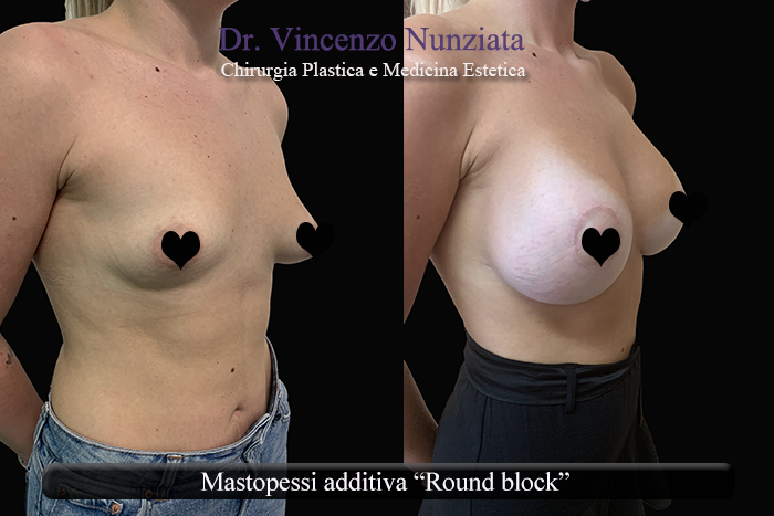 Asimmetrie mammarie prima e dopo – Paziente 8 – Dr. Vincenzo Nunziata, chirurgo plastico – foto 2