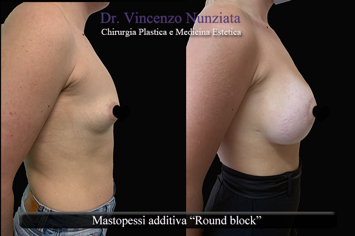 Asimmetrie mammarie prima e dopo – Paziente 8 – Dr. Vincenzo Nunziata, chirurgo plastico – foto 3