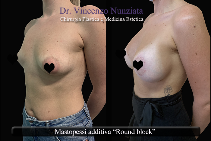 Asimmetrie mammarie prima e dopo – Paziente 8 – Dr. Vincenzo Nunziata, chirurgo plastico – foto 4