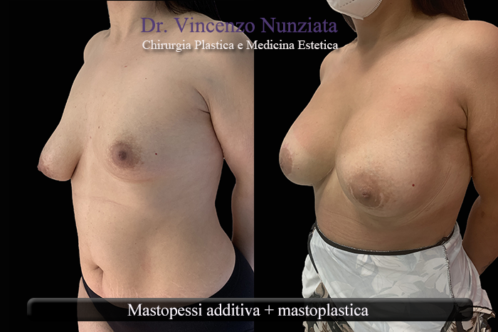 Asimmetrie mammarie prima e dopo – Paziente 7 – Dr. Vincenzo Nunziata, chirurgo plastico – foto 2