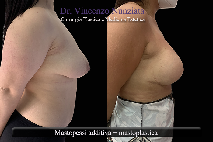 Asimmetrie mammarie prima e dopo – Paziente 7 – Dr. Vincenzo Nunziata, chirurgo plastico – foto 4