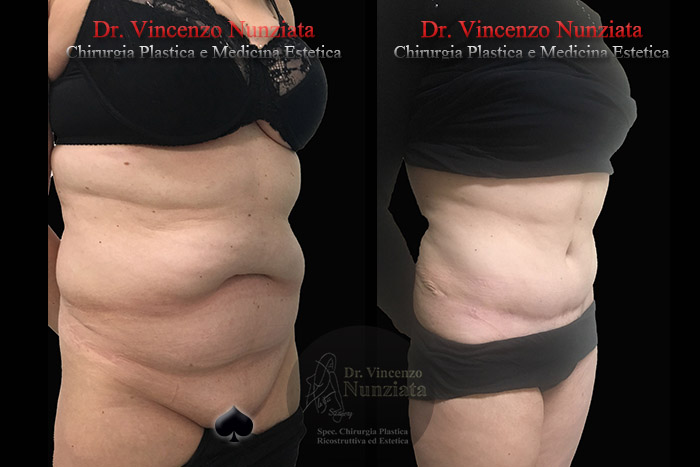 Addominoplastica prima e dopo – Paziente 21 – Dr. Vincenzo Nunziata, chirurgo plastico – foto 3