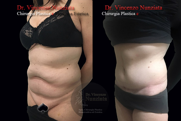 Addominoplastica prima e dopo – Paziente 21 – Dr. Vincenzo Nunziata, chirurgo plastico – foto 2