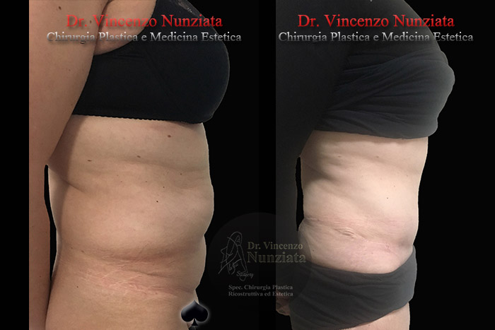 Addominoplastica prima e dopo – Paziente 21 – Dr. Vincenzo Nunziata, chirurgo plastico – foto 4