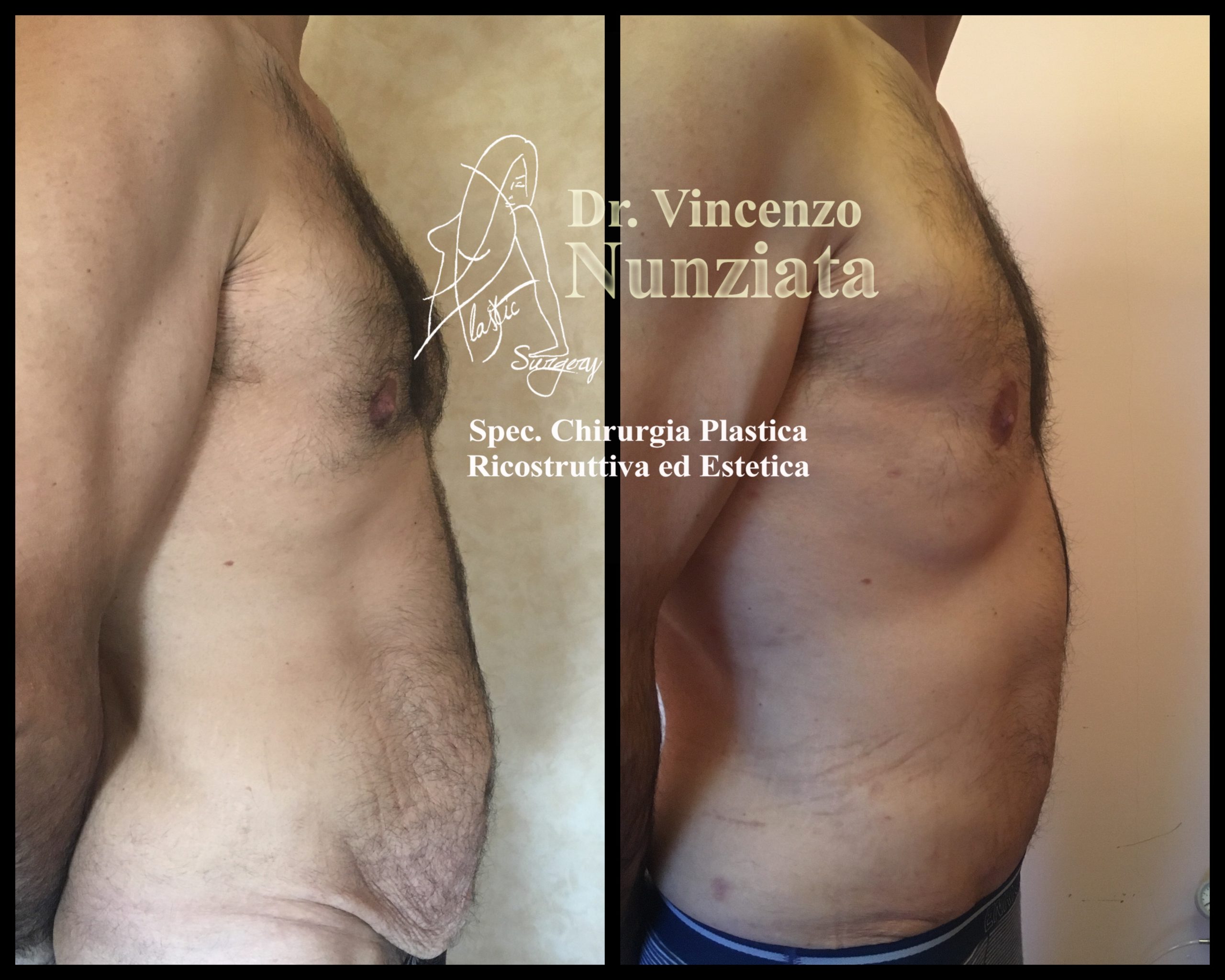 Addominoplastica prima e dopo – Paziente 22 – Dr. Vincenzo Nunziata, chirurgo plastico – foto 3