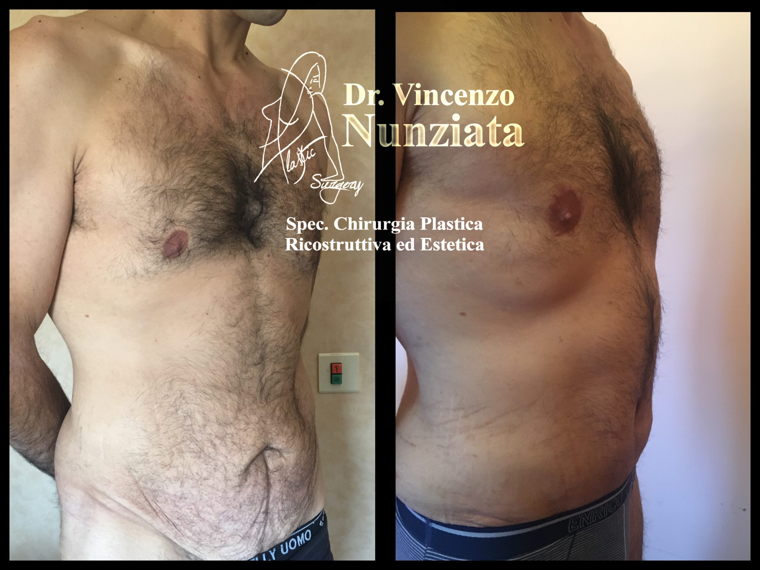 Addominoplastica prima e dopo – Paziente 22 – Dr. Vincenzo Nunziata, chirurgo plastico – foto 2