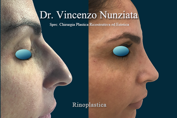 Rinoplastica prima e dopo – Paziente 8 – Dr. Vincenzo Nunziata, chirurgo plastico