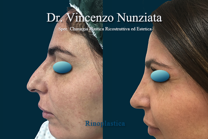 Rinoplastica prima e dopo – Paziente 8 – Dr. Vincenzo Nunziata, chirurgo plastico – foto 3