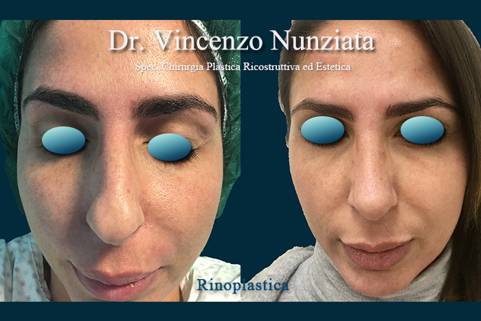 Rinoplastica prima e dopo – Paziente 8 – Dr. Vincenzo Nunziata, chirurgo plastico – foto 2