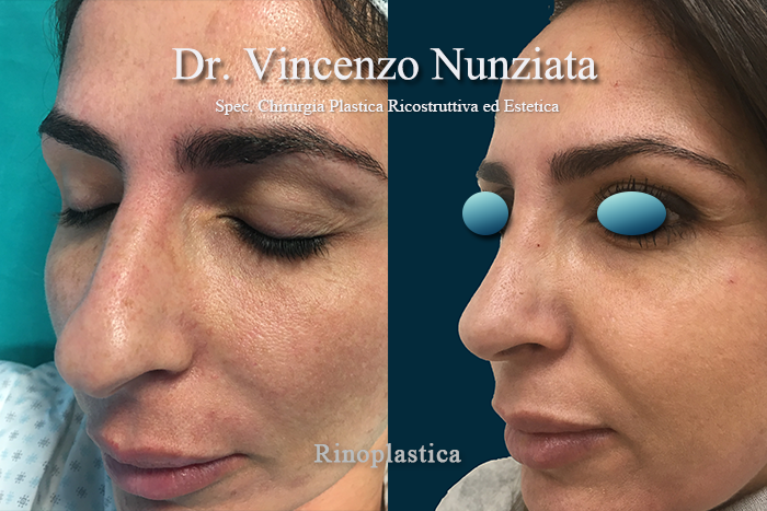 Rinoplastica prima e dopo – Paziente 8 – Dr. Vincenzo Nunziata, chirurgo plastico – foto 4