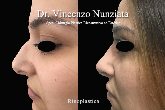 Rinoplastica prima e dopo – Paziente 10 – Dr. Vincenzo Nunziata, chirurgo plastico – foto 2