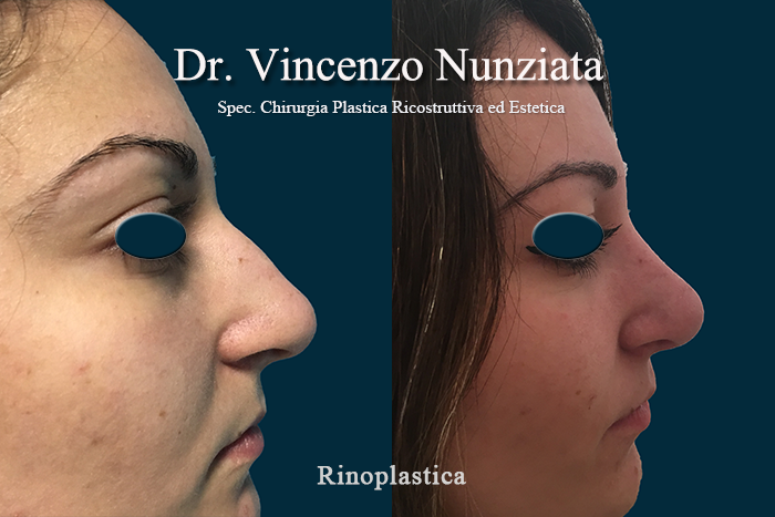 Rinoplastica prima e dopo – Paziente 11 – Dr. Vincenzo Nunziata, chirurgo plastico – foto 2