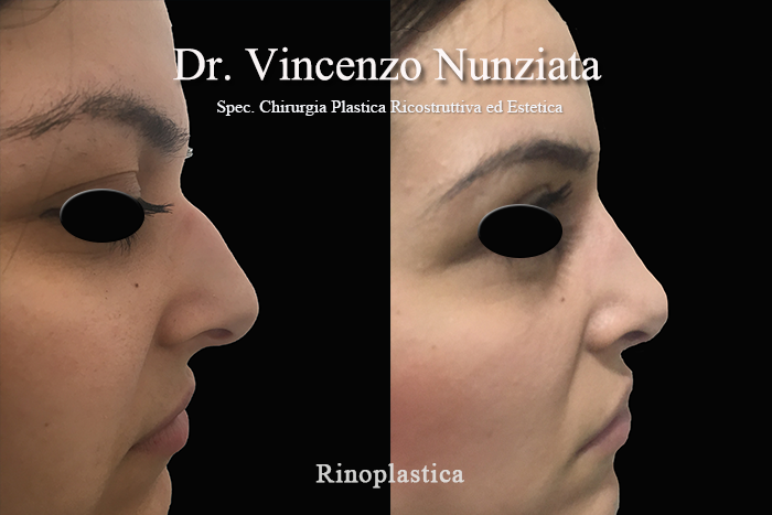 Rinoplastica prima e dopo – Paziente 10 – Dr. Vincenzo Nunziata, chirurgo plastico