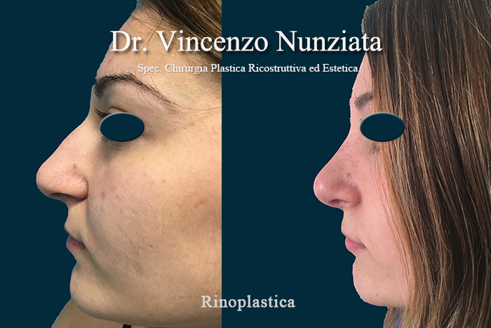 Rinoplastica prima e dopo – Paziente 11 – Dr. Vincenzo Nunziata, chirurgo plastico