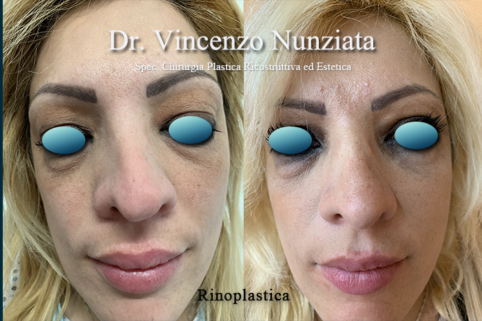 Rinoplastica prima e dopo – Paziente 5 – Dr. Vincenzo Nunziata, chirurgo plastico – foto 2