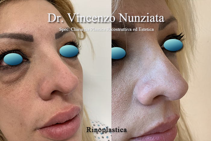 Rinoplastica prima e dopo – Paziente 5 – Dr. Vincenzo Nunziata, chirurgo plastico – foto 3