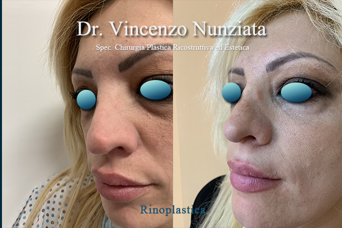 Rinoplastica prima e dopo – Paziente 5 – Dr. Vincenzo Nunziata, chirurgo plastico