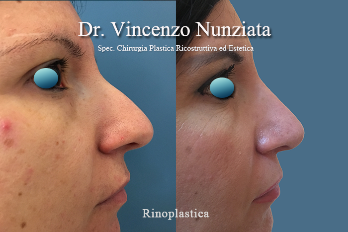 Rinoplastica prima e dopo – Paziente 9 – Dr. Vincenzo Nunziata, chirurgo plastico