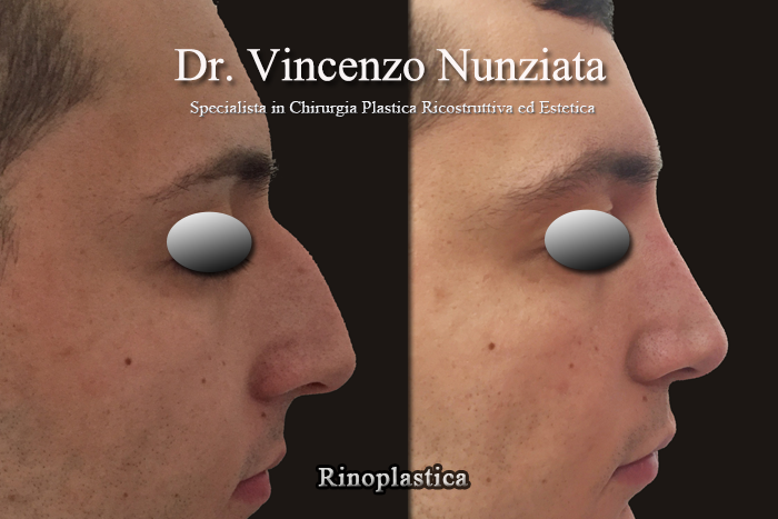Rinoplastica prima e dopo – Paziente 1 – Dr. Vincenzo Nunziata, chirurgo plastico