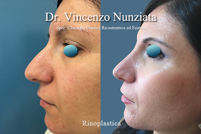 Rinoplastica prima e dopo – Paziente 9 – Dr. Vincenzo Nunziata, chirurgo plastico – foto 3