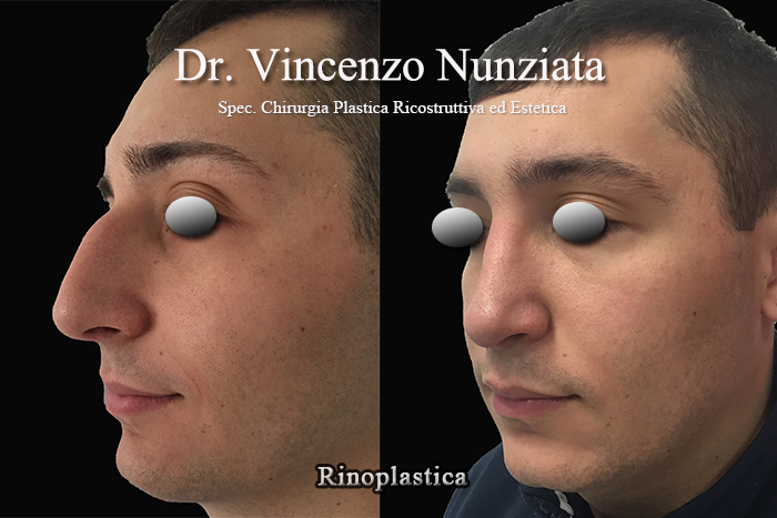 Rinoplastica prima e dopo – Paziente 1 – Dr. Vincenzo Nunziata, chirurgo plastico – foto 2
