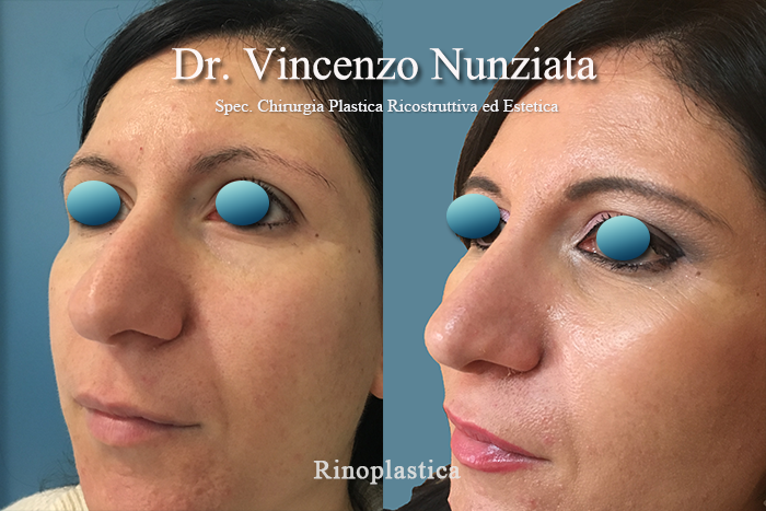 Rinoplastica prima e dopo – Paziente 9 – Dr. Vincenzo Nunziata, chirurgo plastico – foto 2