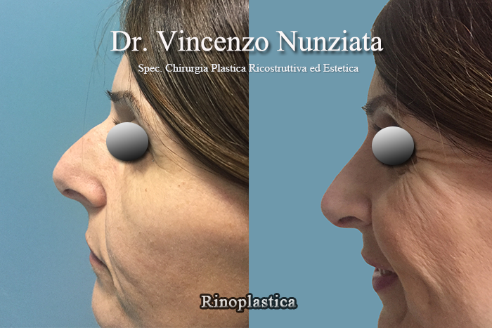 Rinoplastica prima e dopo – Paziente 2 – Dr. Vincenzo Nunziata, chirurgo plastico