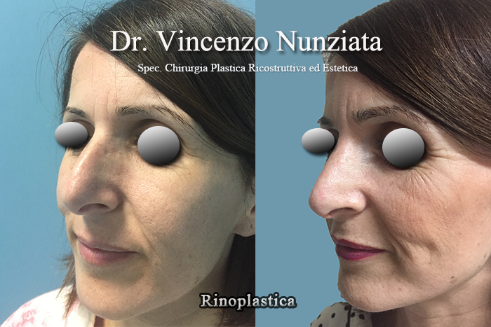 Rinoplastica prima e dopo – Paziente 2 – Dr. Vincenzo Nunziata, chirurgo plastico – foto 3