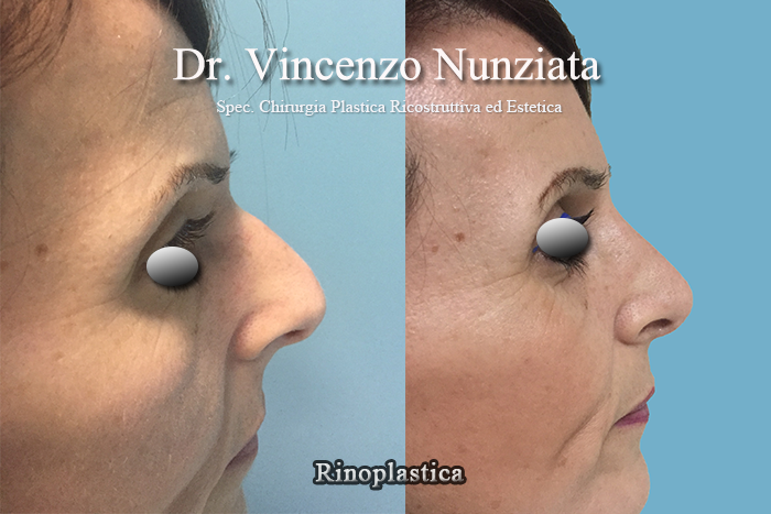 Rinoplastica prima e dopo – Paziente 2 – Dr. Vincenzo Nunziata, chirurgo plastico – foto 2