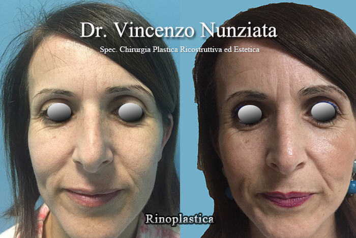 Rinoplastica prima e dopo – Paziente 2 – Dr. Vincenzo Nunziata, chirurgo plastico – foto 4