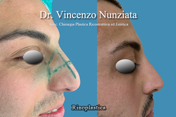 Rinoplastica prima e dopo – Paziente 3 – Dr. Vincenzo Nunziata, chirurgo plastico