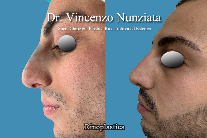 Rinoplastica prima e dopo – Paziente 3 – Dr. Vincenzo Nunziata, chirurgo plastico – foto 2