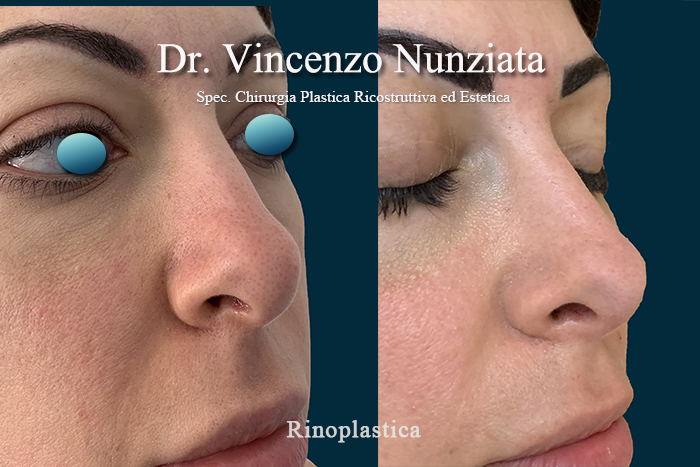 Rinoplastica prima e dopo – Paziente 6 – Dr. Vincenzo Nunziata, chirurgo plastico