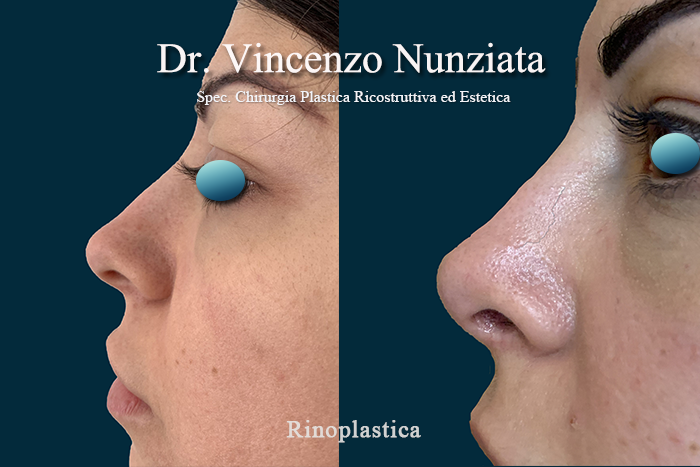 Rinoplastica prima e dopo – Paziente 6 – Dr. Vincenzo Nunziata, chirurgo plastico – foto 2