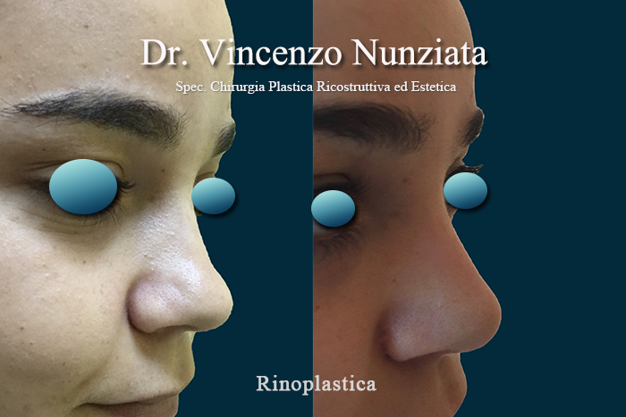 Rinoplastica prima e dopo – Paziente 7 – Dr. Vincenzo Nunziata, chirurgo plastico