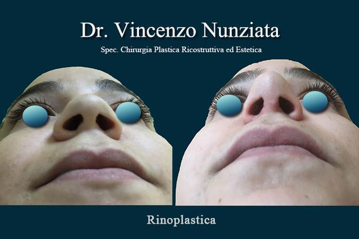 Rinoplastica prima e dopo – Paziente 7 – Dr. Vincenzo Nunziata, chirurgo plastico – foto 3