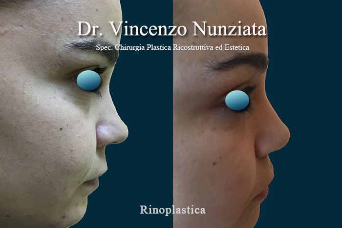 Rinoplastica prima e dopo – Paziente 7 – Dr. Vincenzo Nunziata, chirurgo plastico – foto 2