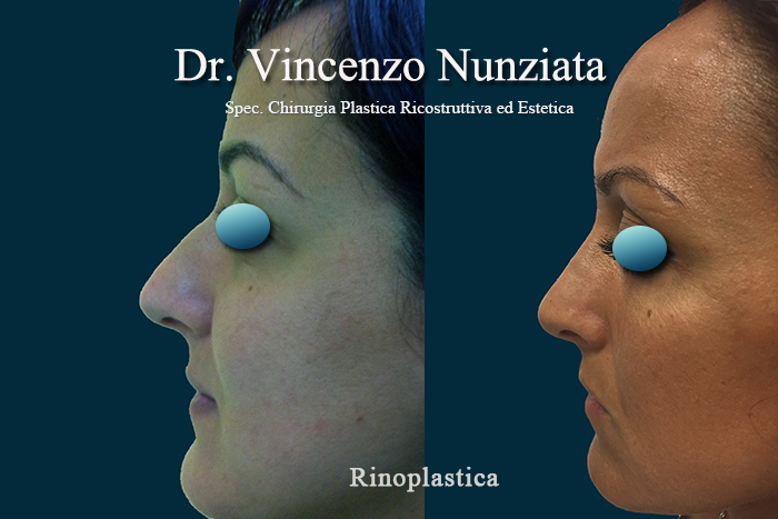 Rinoplastica prima e dopo – Paziente 4 – Dr. Vincenzo Nunziata, chirurgo plastico – foto 2