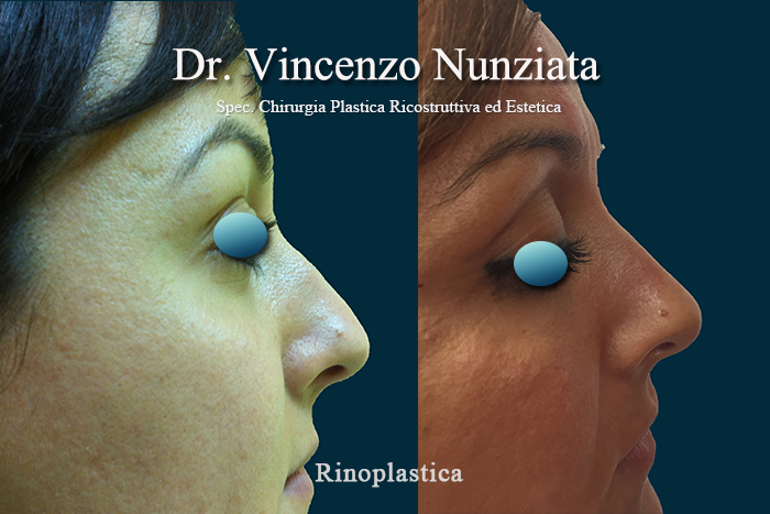 Rinoplastica prima e dopo – Paziente 4 – Dr. Vincenzo Nunziata, chirurgo plastico