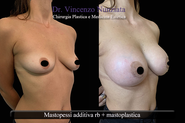 Asimmetrie mammarie prima e dopo – Paziente 9 – Dr. Vincenzo Nunziata, chirurgo plastico – foto 1